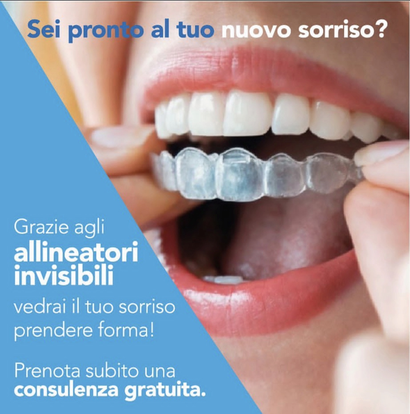 Allineatori trasparenti